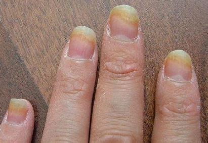 Fingernail Fungus - Treatment, How to Get Rid, Pictures, Home Remedies