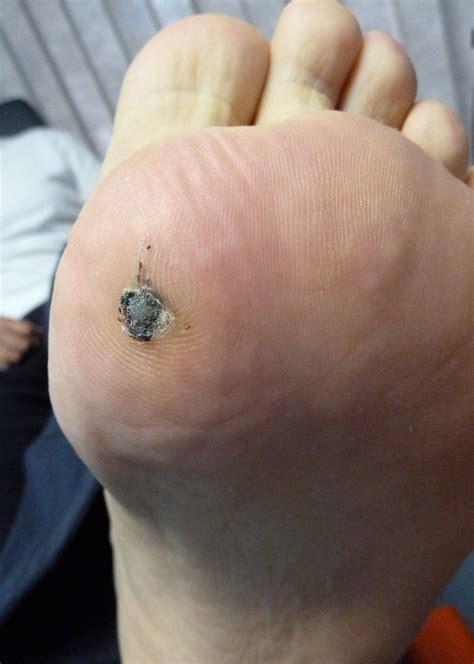 Plantar Wart Treatment | brightonpodiatry.com.au