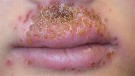 Treating Eczema On Lips | Lipstutorial.org