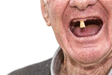 Tooth loss and ageing - not as straight forward as you think