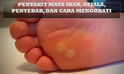 Penyebab Penyakit Mata Ikan di Kaki dan Cara Mengatasinya - Parboaboa