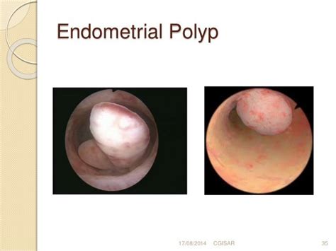 Role of hysteroscopy in Infertility, Dr Rajesh Gajbhiye