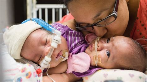 Texas Conjoined Twins Await Surgery to Lead Separate Lives - Good Morning America
