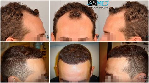 Norwood 3 Hair Transplantation Results | Asmed Hair Transplant