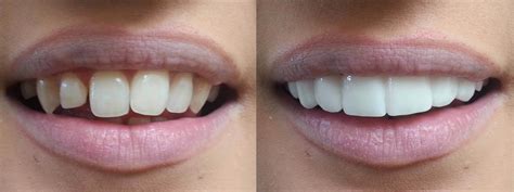 What are clip on veneers? | News | Dentagama