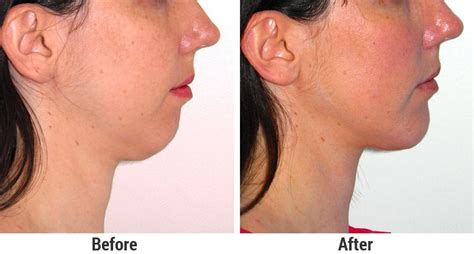 every thing you need to know about Chin Implant surgery