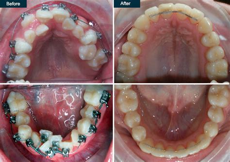 Ceramic Braces Before And After