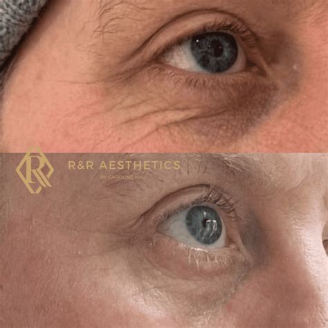 POLYNUCLEOTIDE SKIN REJUVENATION - R&R Aesthetics