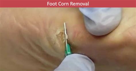 How to Treat Foot Corn? - Causes of Foot Corn, Treatment