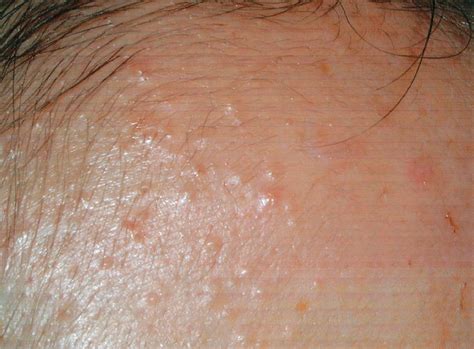 Pityrosporum Folliculitis | Acne | JAMA Pediatrics | The JAMA Network