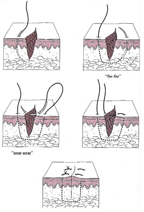 Surgical suture, types of sutures, sizes, how to suture & suture removal times