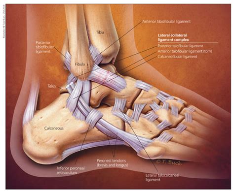 Calcaneofibular Ligament Injury