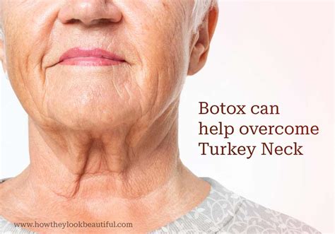 Where on Your Face Can You Get Botox Injected? (With Units)