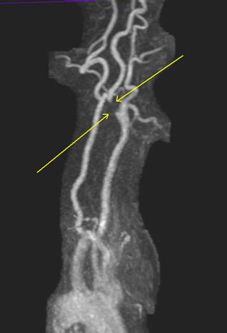 MRA NECK WITH AND WITHOUT IV CONTRAST - Greater Waterbury Imaging Center