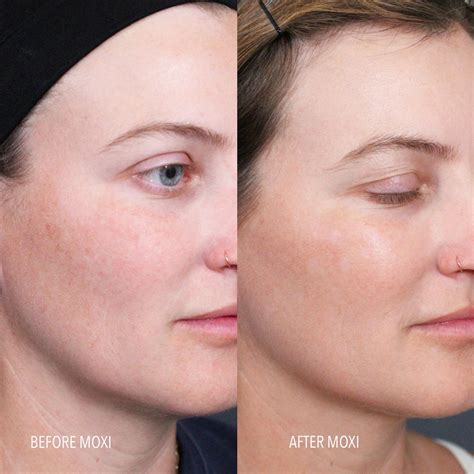 I Tried the Moxi Laser Treatment: See Photos | POPSUGAR Beauty