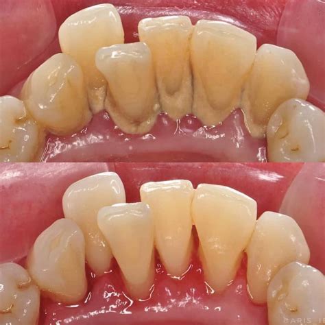 Teeth scaling is removing the tartar deposits from the teeth with the ...