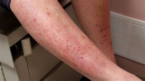 Blåsdermatoser: Dermatitis herpetiformis | Praktisk Medicin