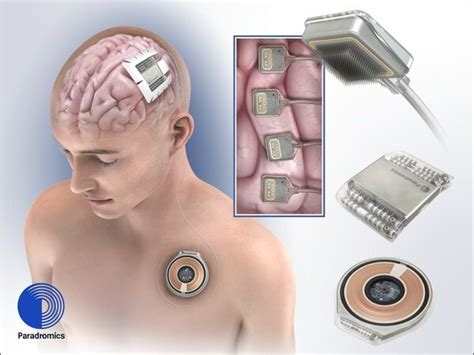 Paradromics, a Neuralink Competitor, Is Set To Start Testing Its Brain Implant Next Year ...