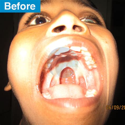 Cleft Palate Incomplete - Cleft Surgery In Karachi - Dr. Ashraf Ganatra