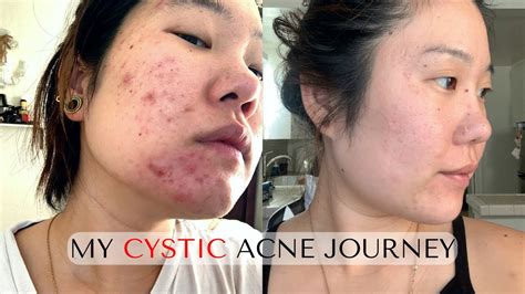 How I Treated My Cystic Hormonal Adult Acne - YouTube