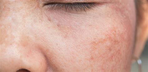 Hyperpigmentation Treatments | Santa Barbara | TMA