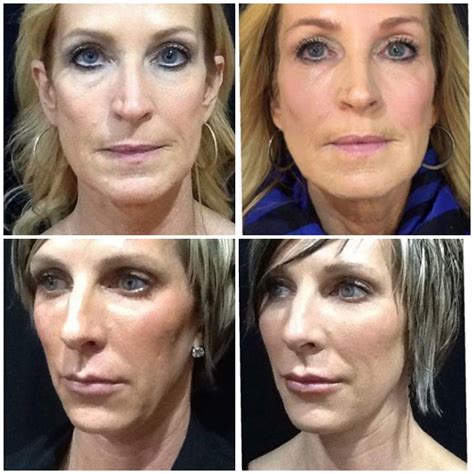 Sculptra Duluth MN | Smile Line Fillers Northern Minnesota | Twin Ports Dermatology & Med Spa