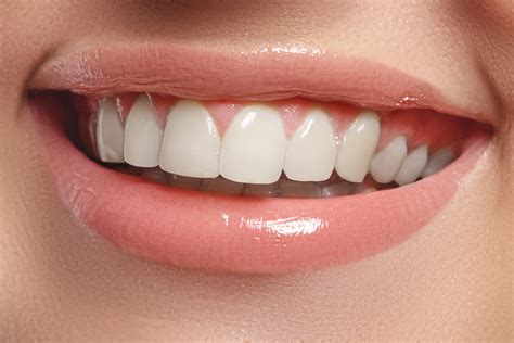 The perfect dental alignment treatment may be Invisalign London - Women's Health Blog