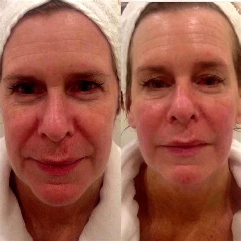 Before And After Of Thermage (10) » Facelift: Info, Prices, Photos ...