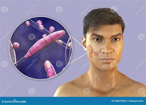 Fungal Infection on a Man S Face, 3D Illustration Stock Illustration ...