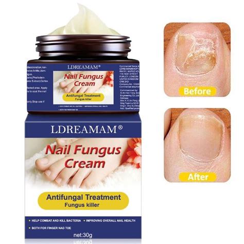 Fungus Treatment Cream,Nail Fungus Cream,Foot Fungus,Fungus Stop,Anti fungal Nail,Restores the ...