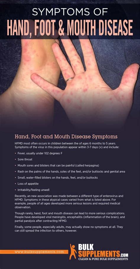 Hand, Foot, and Mouth Disease (HFMD): Symptoms, Causes & Treatment