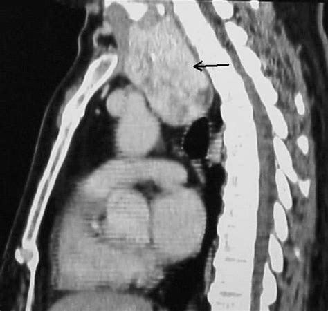 Resection of an Intrathoracic Thyroid Gland | CTSNet