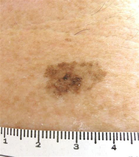 What’s new in early-stage melanoma? | AAD