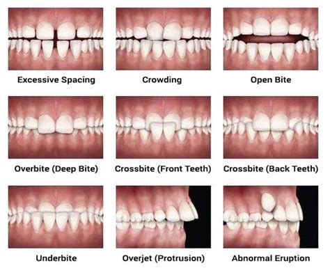 Underbite vs. Overbite: What’s the Difference and How are They Treated ...