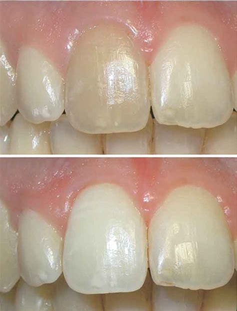 Non-vital (Internal) Bleaching – prestige-dental-care.com.my