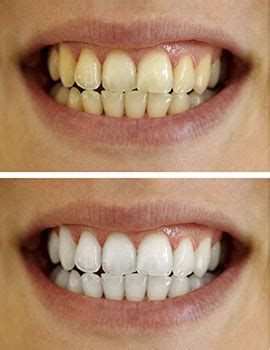 Teeth Bleaching Before And After