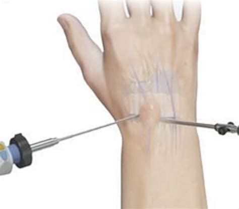 Wrist arthroscopy - Surrey Orthopaedic Clinic