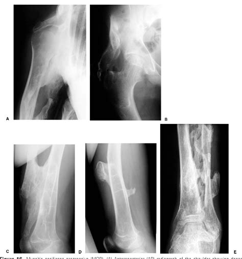 Figure 16 from The imaging of myositis ossificans. | Semantic Scholar