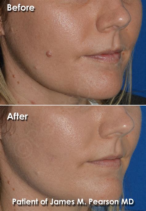 Mole Removal Photos - Before & After - Dr. James Pearson Facial Plastic ...