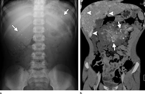 Blue rubber bleb nevus syndrome in an 8-year-old boy who presented with ...