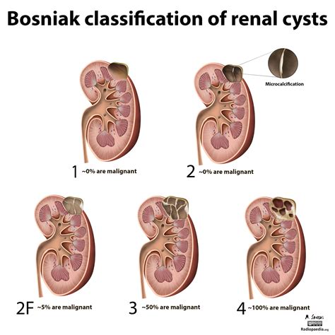 Resultado de imagen de bosniak classification | Kidney cyst, Renal, Cysts