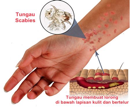 Cara Menyembuhkan Penyakit Kulit Kudis, Gudik, Scabies Secara Alami | QnC Jelly Gamat