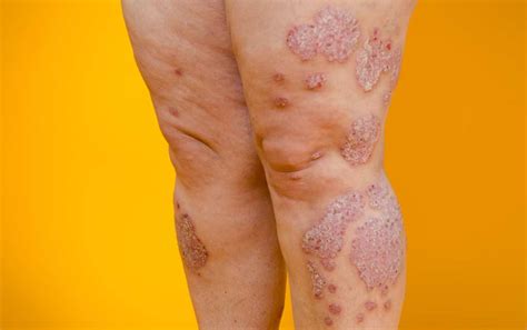 Living with Psoriasis