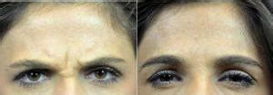 Botox Brow Furrow Before & After » Facial Injections: Info, Prices, Photos, Reviews, Q&A