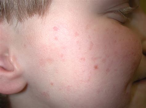 Keratosis Pilaris On The Face - Keratosis Pilaris Treatment Options