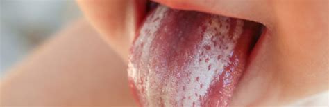 Oral Thrush Symptoms, Causes and Treatments Explained | Nature's Best