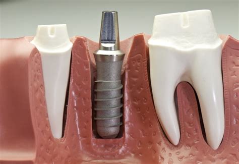 Learn More About the Benefits of Titanium Dental Implants