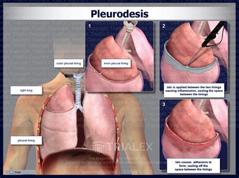 Pleurodesis - Trial Exhibits Inc.