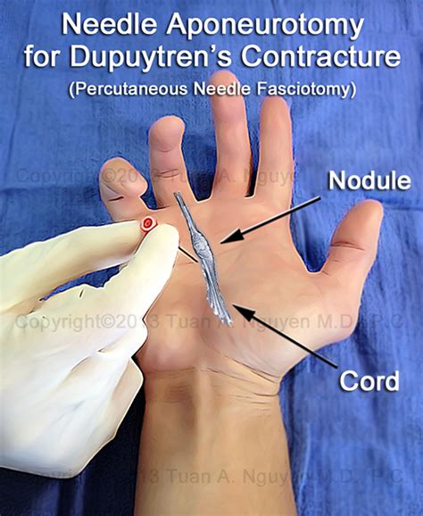 Needle Aponeurotomy for Dupuytren's Contracture - Lake Oswego Hand Surgery Acupressure Massage ...