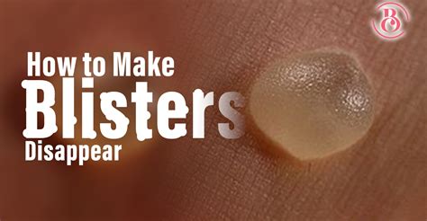 4 Sure Ways to Make Blisters Disappear - BeauCrest